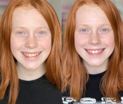 girl yellow teeth austin teeth whitening after white teeth laser davinci