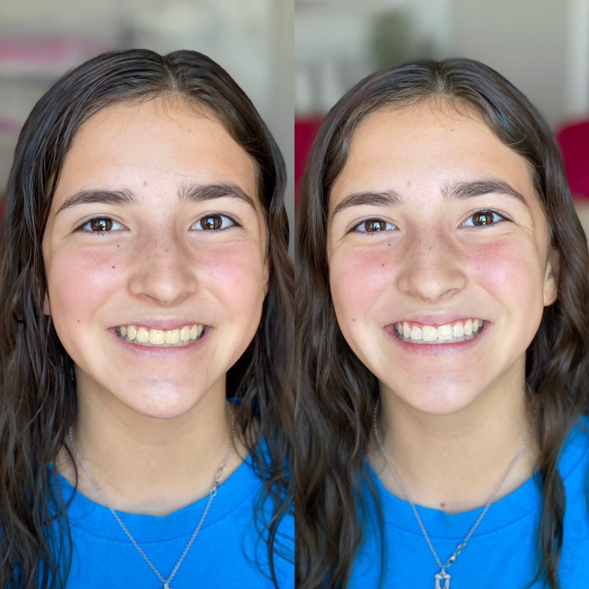 young girl austin teeth whitening before after laser davinci