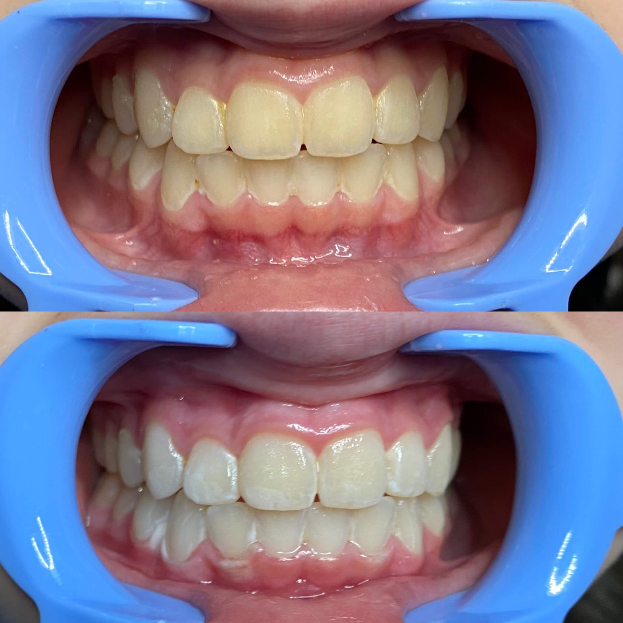 yellow teeth before white teeth after austin teeth whitening laser davinci