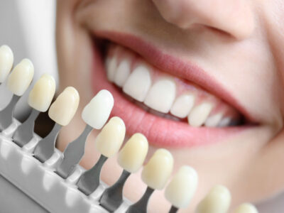 laser teeth whitening austin teeth whitening davinci technology