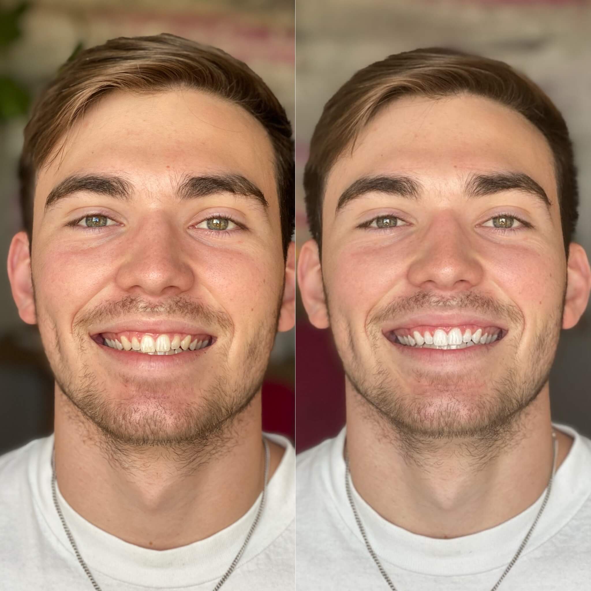 young man before after austin teeth whitening laser davinci